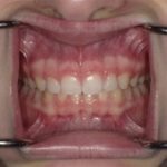 Memphis tn invisalign