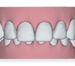 overbite illustration