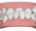 underbite illustration